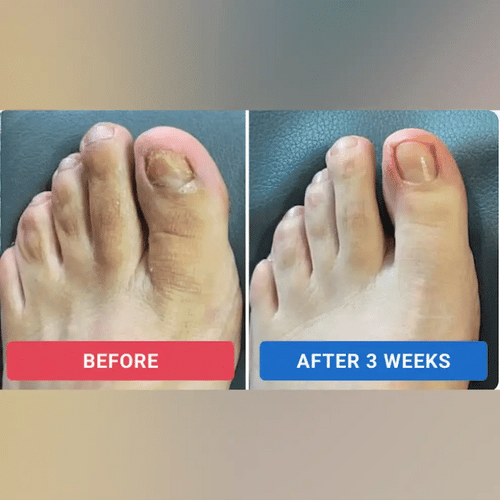 Maanufo Fungal Nail Renewal Patches