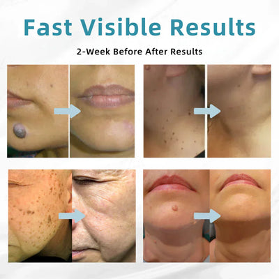 VelvetSkin+ All-in-One Laser Eraser Pen