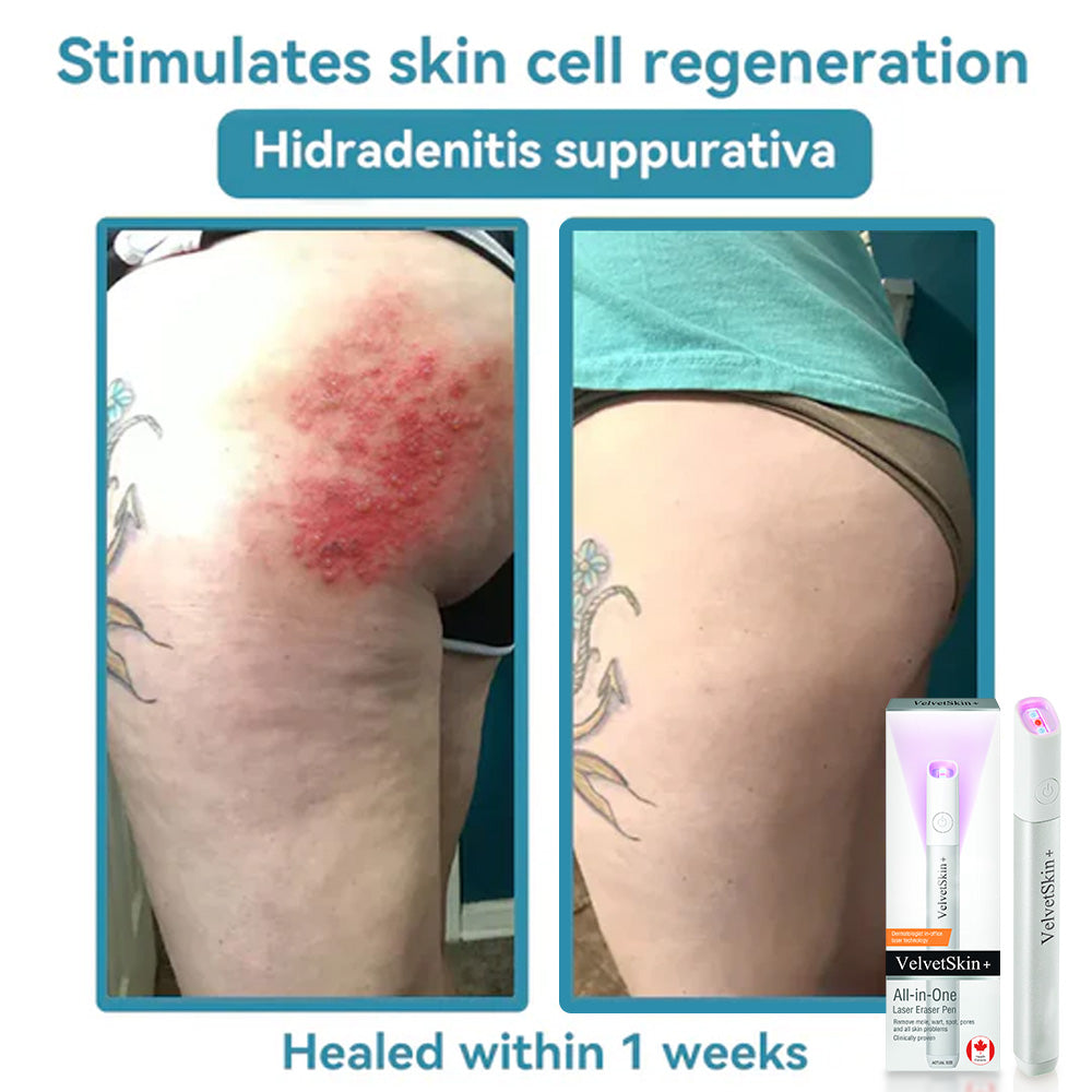 VelvetSkin+ All-in-One Laser Eraser Pen