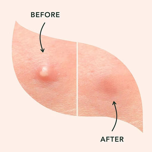 Pimple Patches