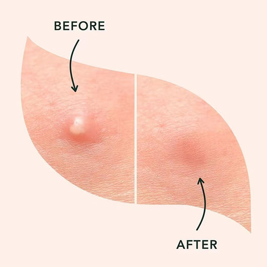 Pimple Patches