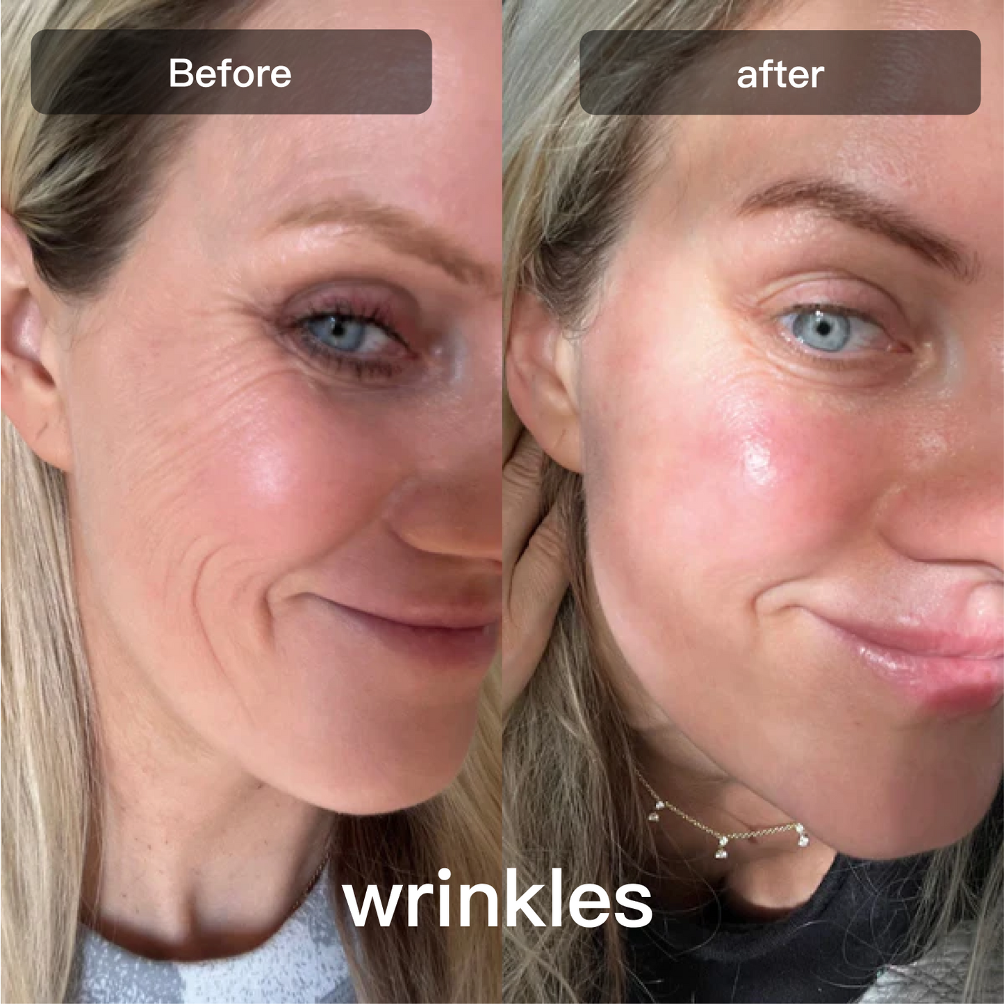 LED Light Therapy Device