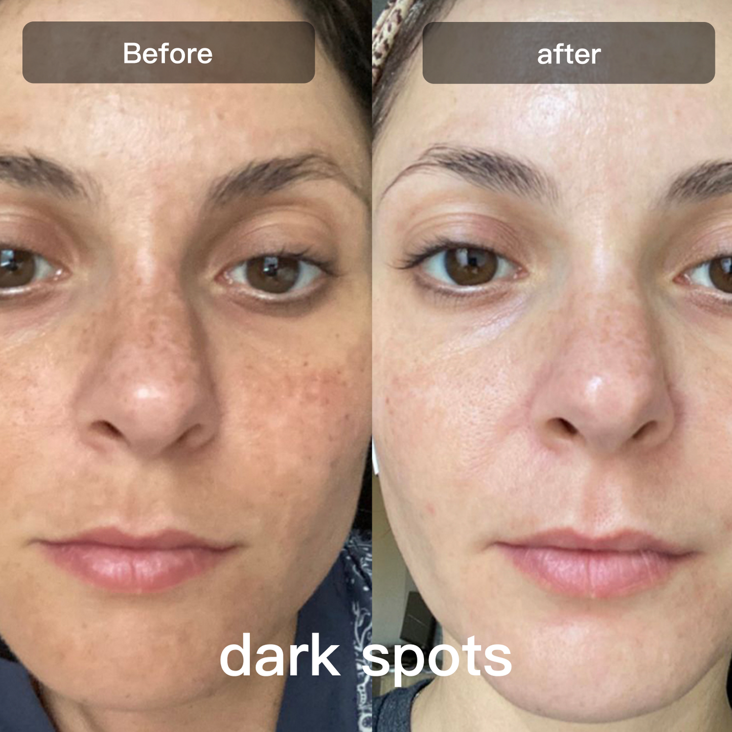 LED Light Therapy Device