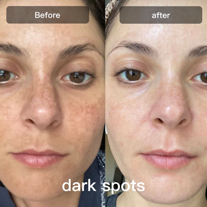 LED Light Therapy Device