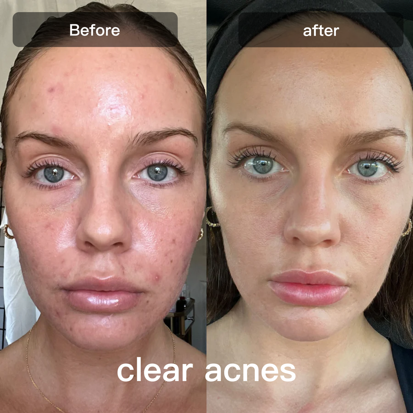 LED Light Therapy Device